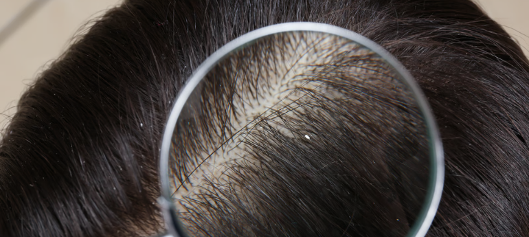 Close-up of a scalp viewed through a magnifying glass, showing diffuse thinning