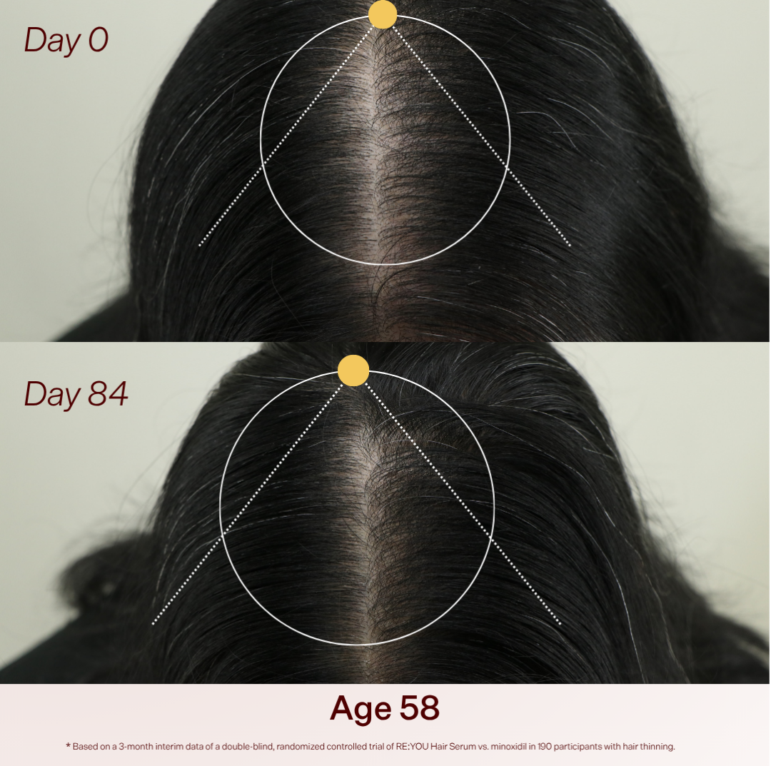 Before and after scalp photos at Day 0 and Day 84 for a 58-year-old participant