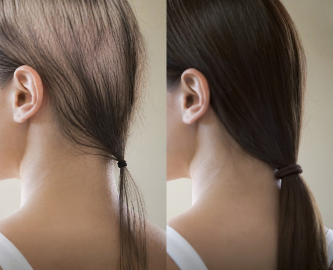 Woman in her 40s examining hair thinning at the crown — a common presentation of perimenopausal hair loss