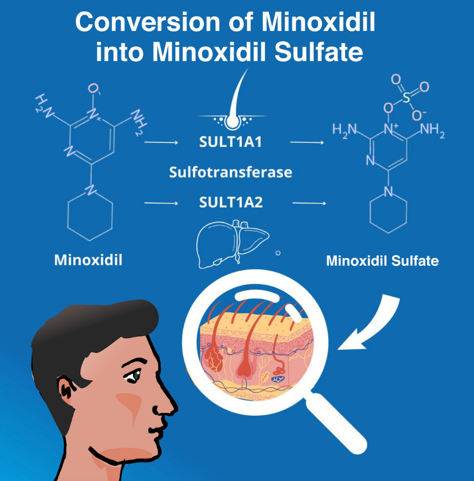 Diagram showing conversion of minoxidil into minoxidil sulfate by SULT1A1 in the hair follicle and SULT1A2 in the liver