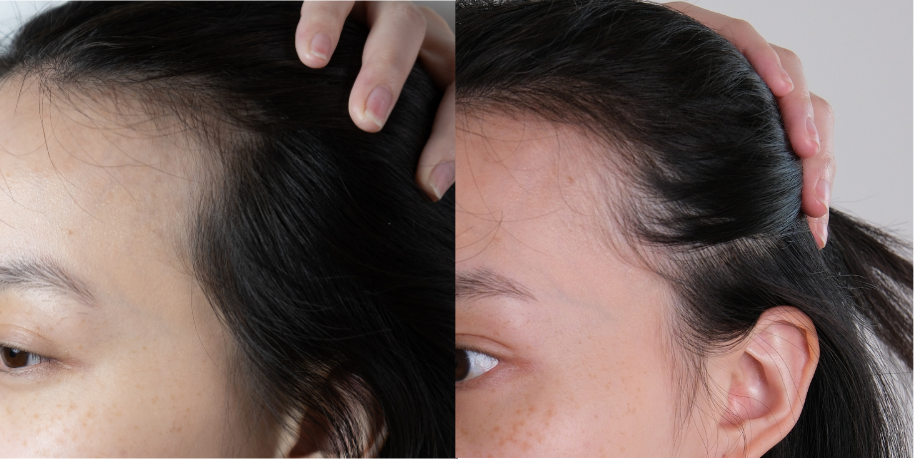 Before and after of a woman&rsquo;s hairline after 30 days of daily RE:YOU use, with short baby hairs more visible along the hairline