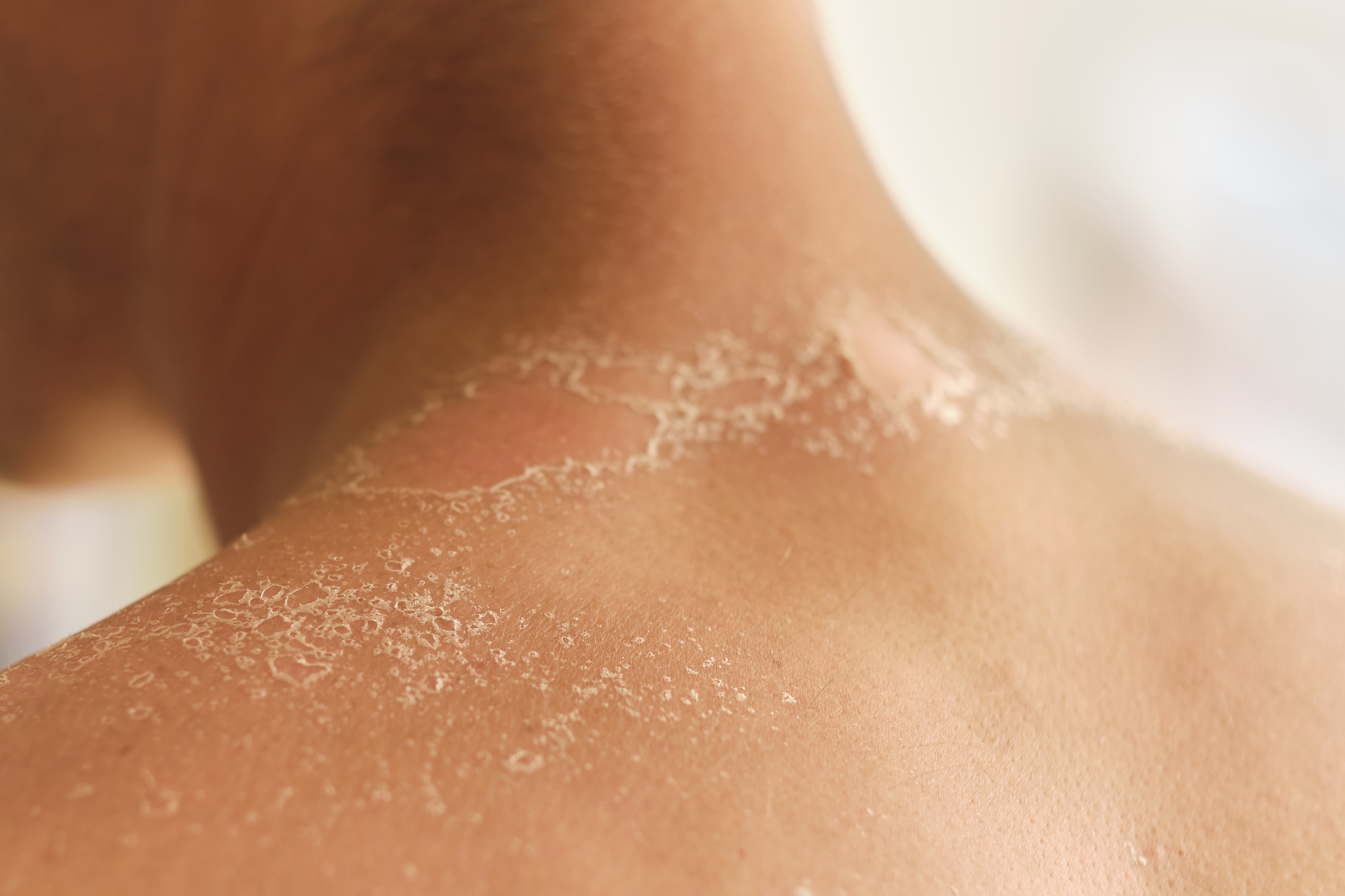 Close-up of facial skin showing redness and flushing