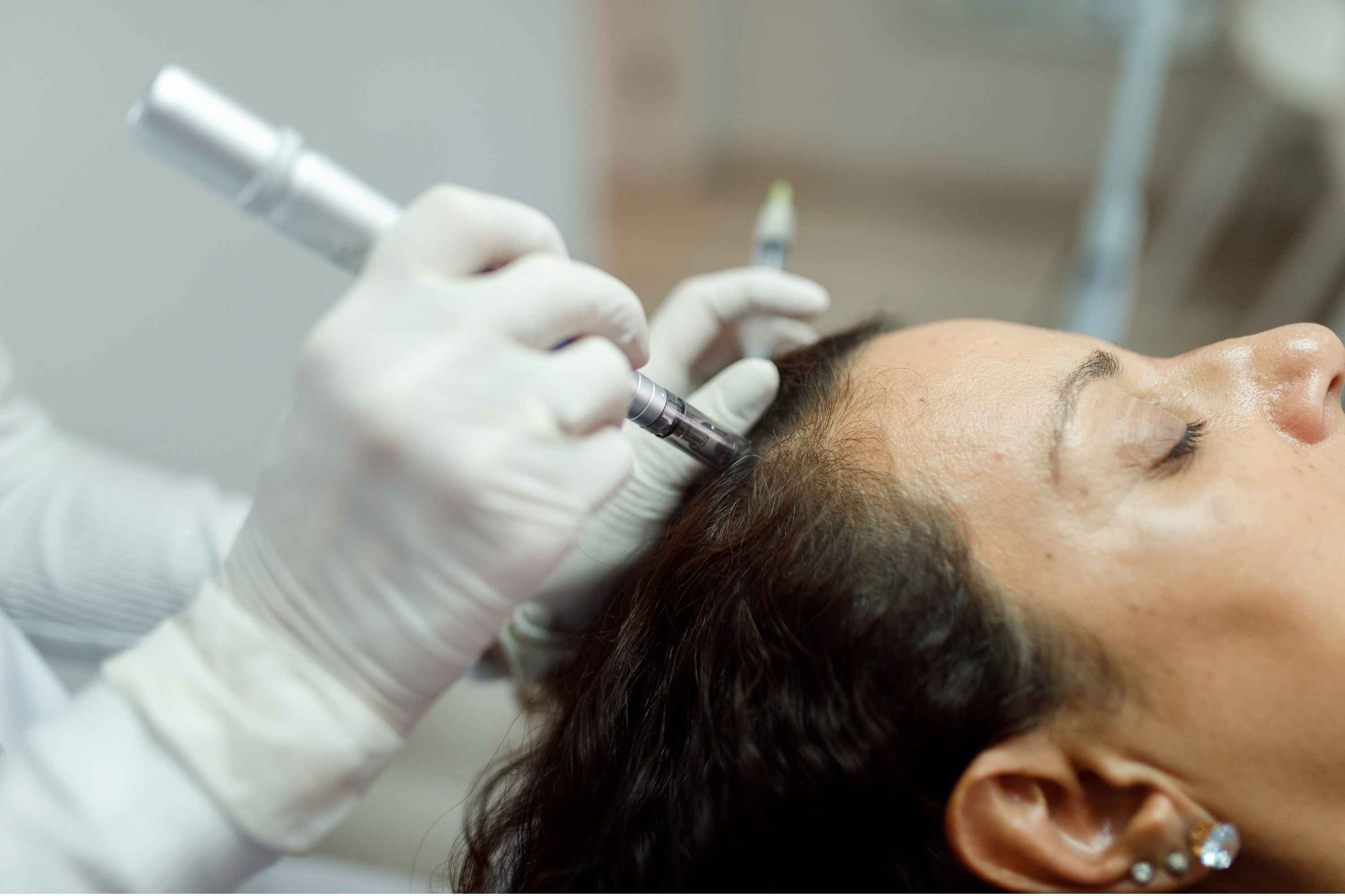 A dermaroller used on the scalp