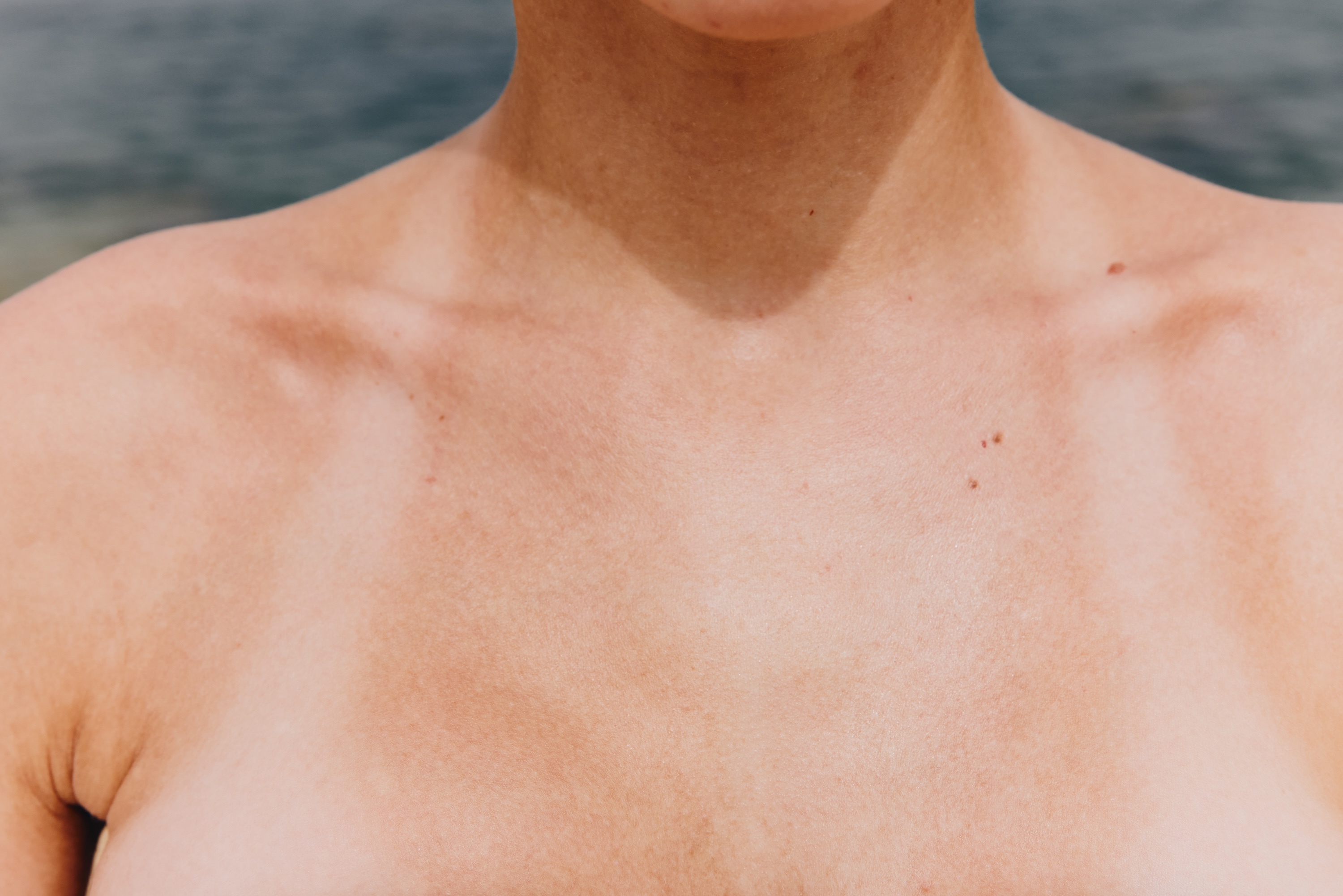 Person at beach with visible tan lines showing uneven sun protection
